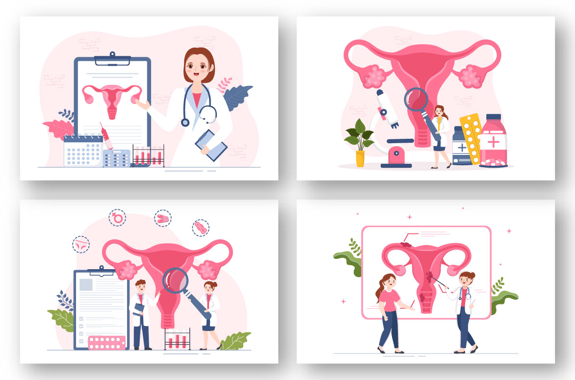 Endometriosis Illustration preview image.