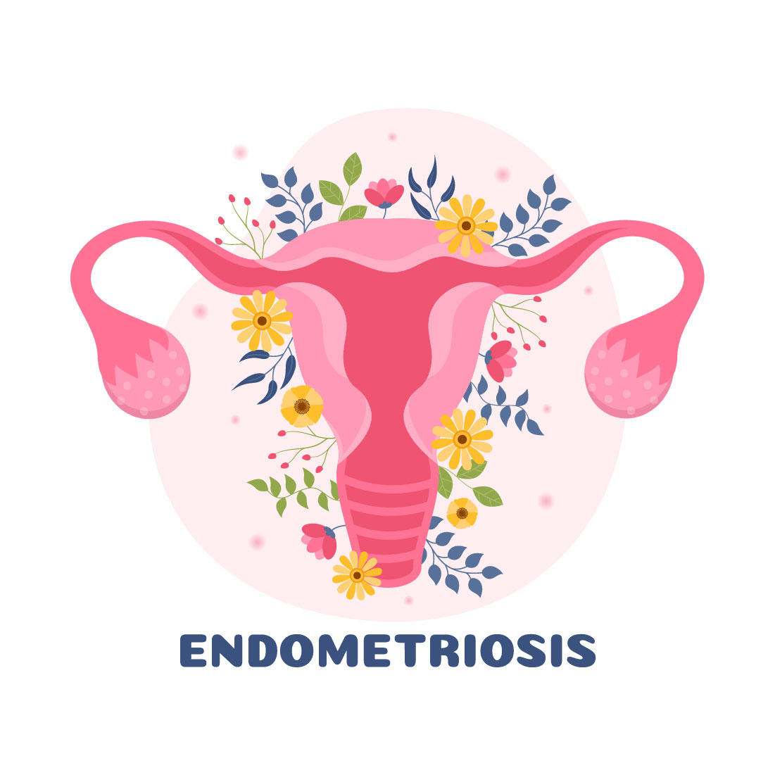 Endometriosis Illustration cover image.