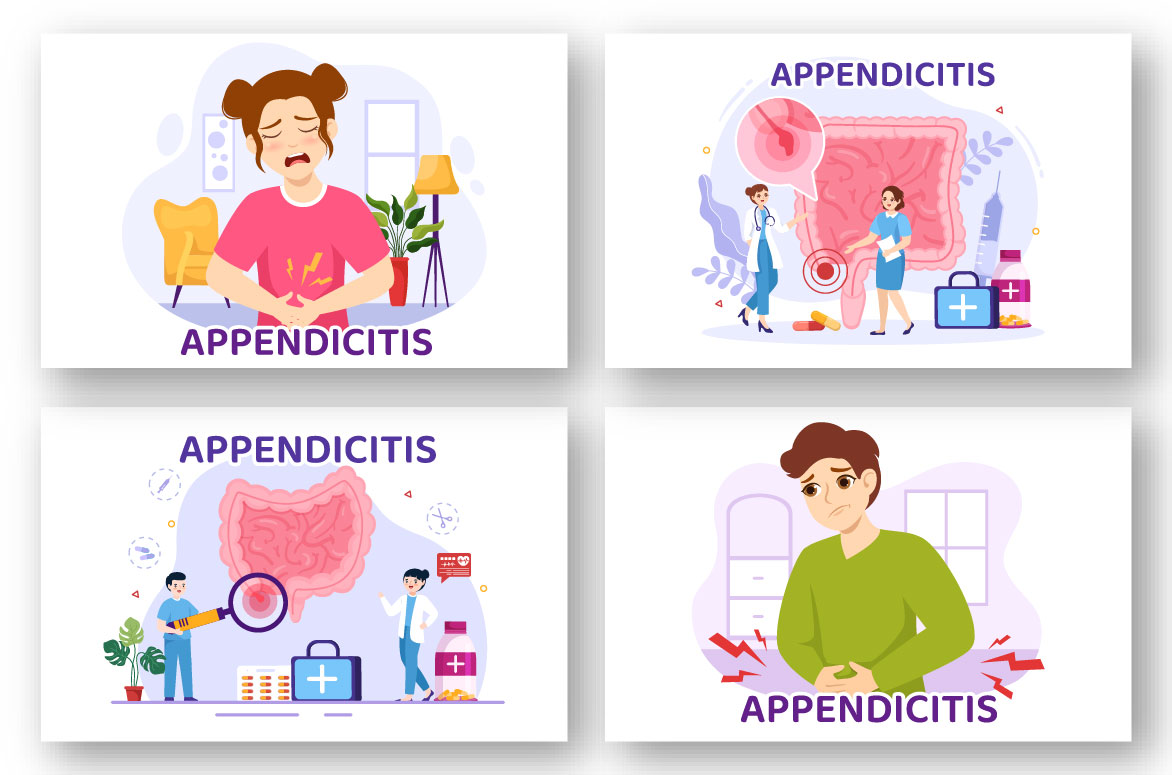 Four different types of appendicities.