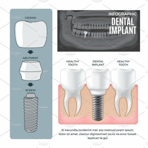 Infographic Dental Implant Structure Info Poster cover image.