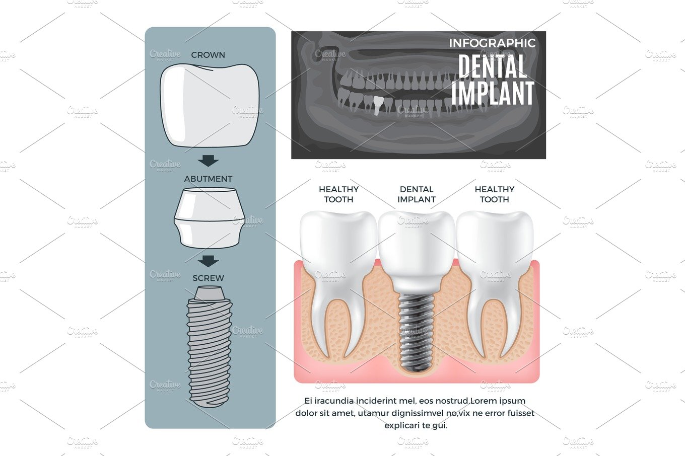Infographic Dental Implant Structure Info Poster cover image.