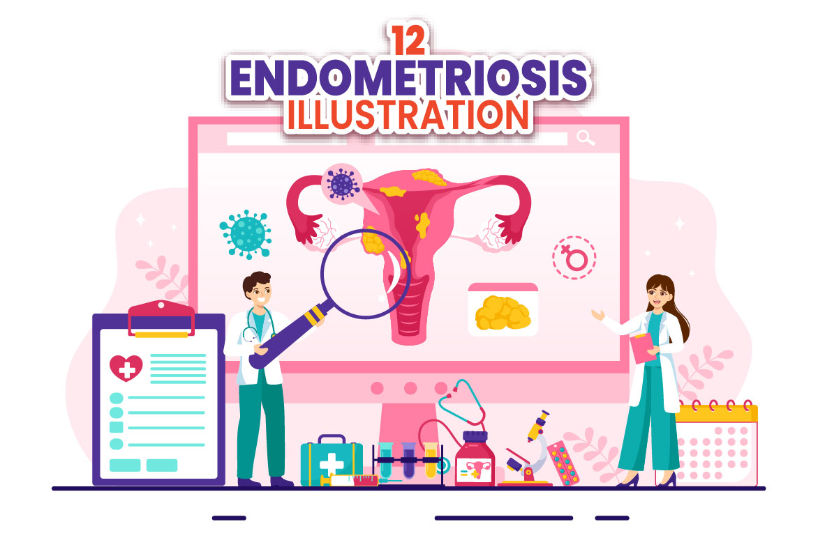 endometriosis 01 517