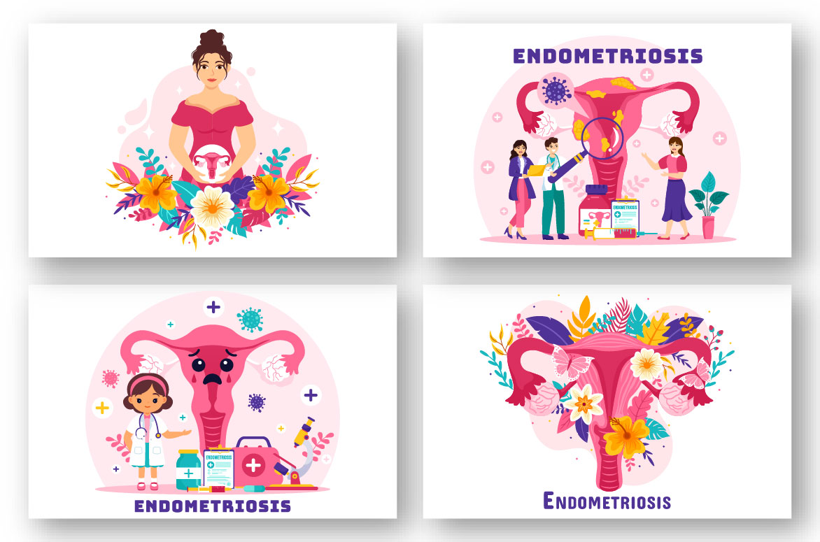 endometriosis 02 36