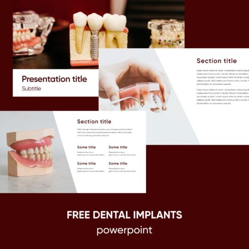 Images with Dental Implants Powerpoint.